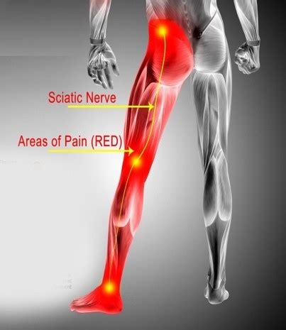 why sciatica pain occurs